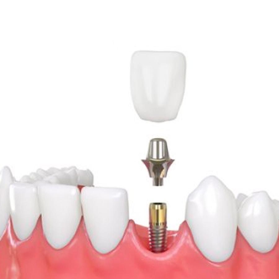 Improve Your Smile & Confidence With Dental Implants : A Guide